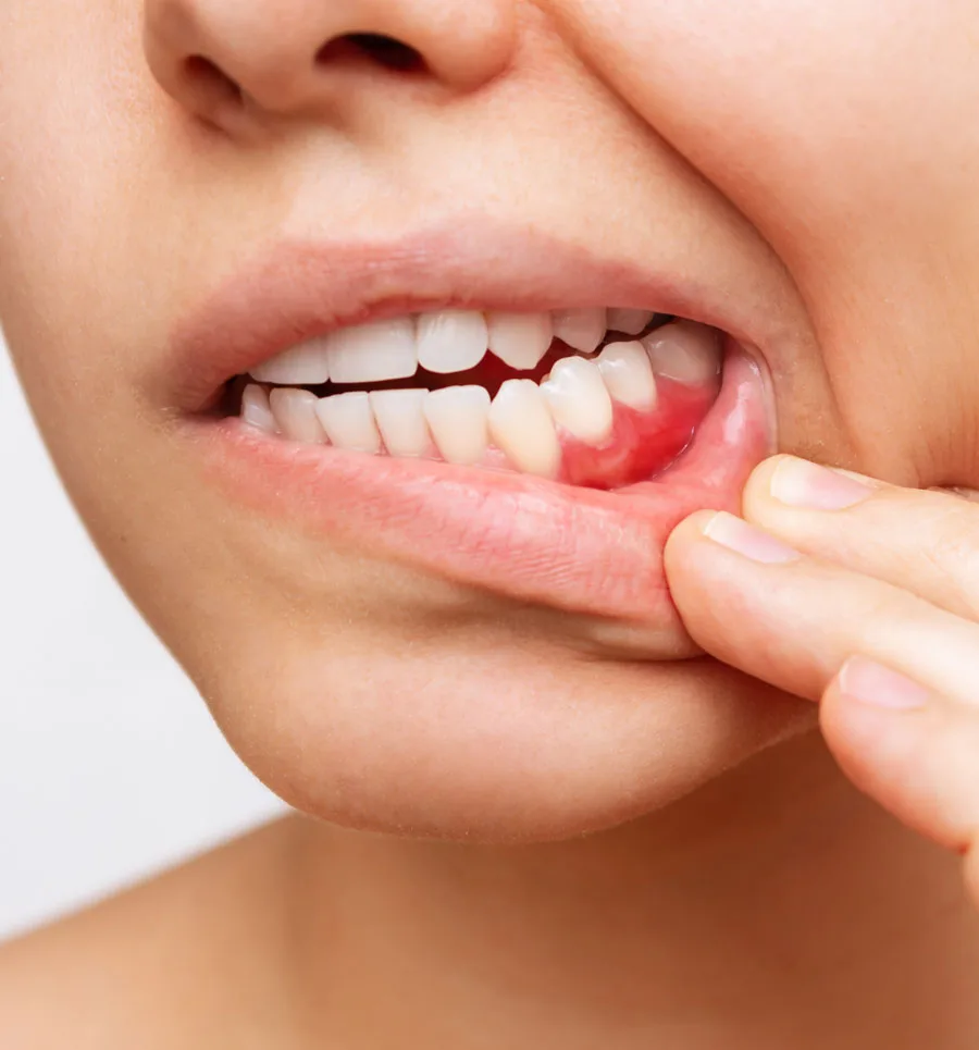 Stan zapalny struktur jamy ustnej